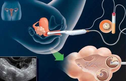 广州代生医生咨询 广州试管婴儿费用是多少?广州三代试管周期多久? ‘怎么通