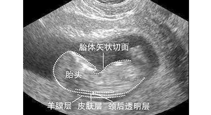 助孕医院哪家较好_找个女的助孕的多少钱_NT检查大揭秘！新竹市做三代试管婴